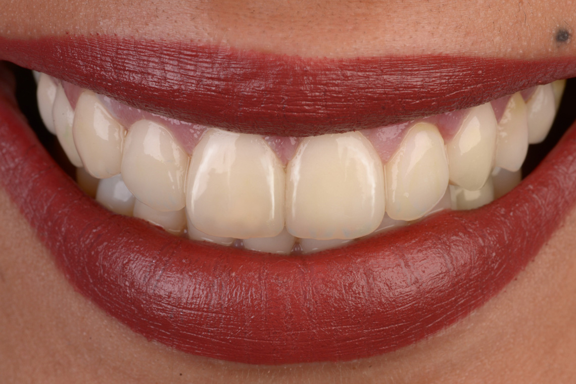 Risultato estetico con VITA ENAMIC®
